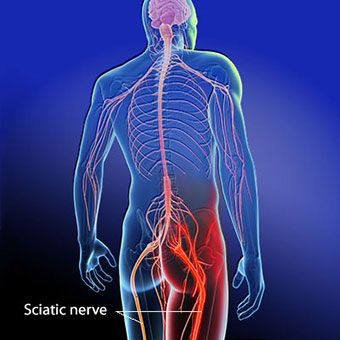 Researchers Reveal 14 Common Causes of Sciatic Nerve Pain