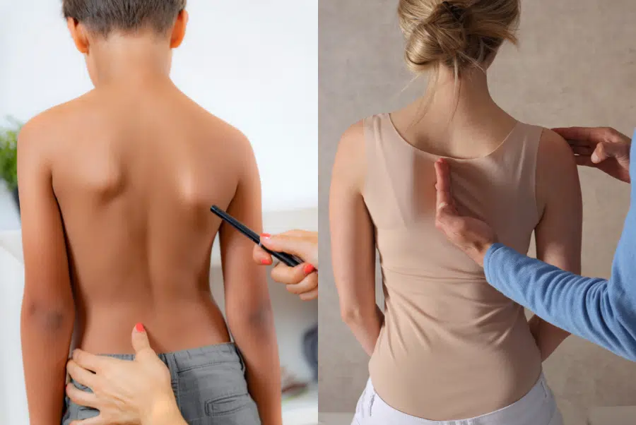 Causes of Scoliosis - Uneven Shoulders or Hips